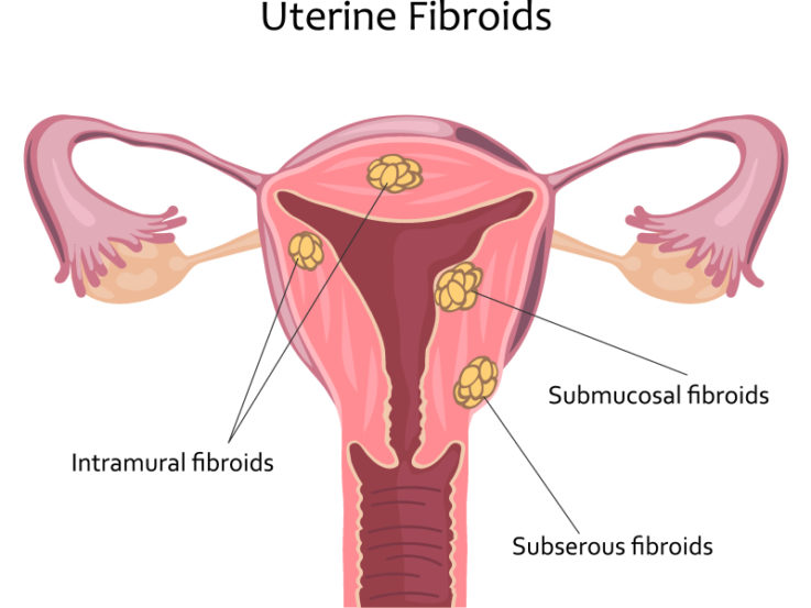 Fibroids