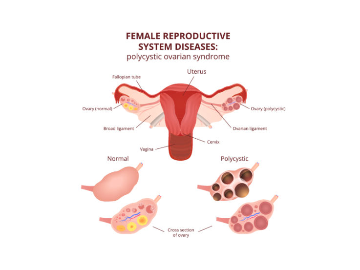Poly-cystic-ovaries